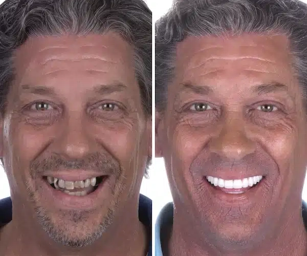 Veneers- Custom Porcelain by South Bay Dental- Masoud Before and After