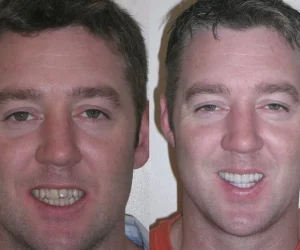 Smile Makeover at Green dental- Before & After#2