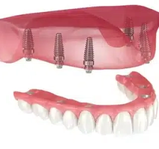 Dental Implants to replace Dentures