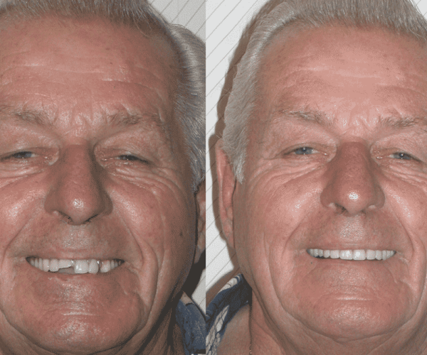 Dentures replaced with Dental Implants