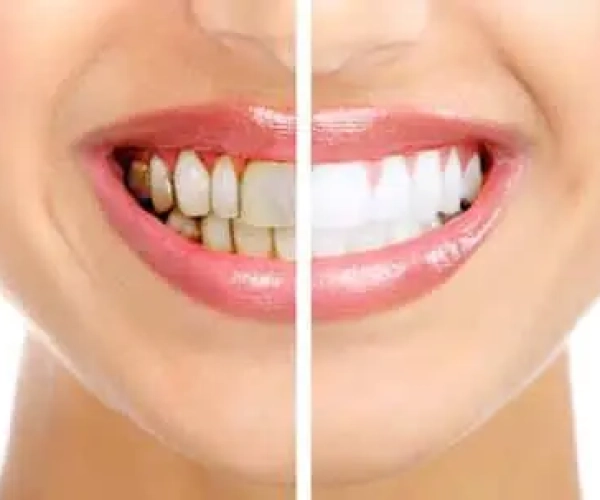 Healthy beautiful smile. Dental health. Whitening