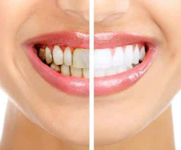 Healthy beautiful smile. Dental health. Whitening.