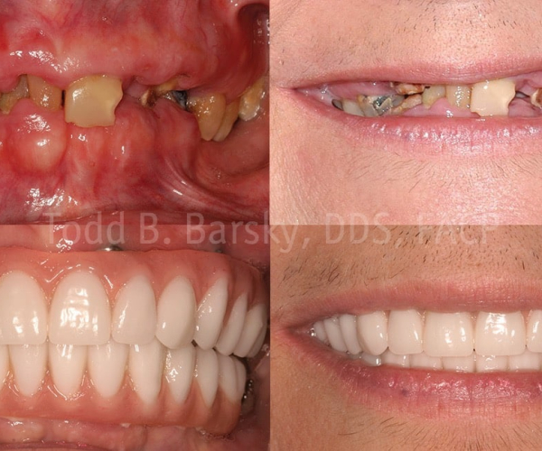 all-on-4-dental-implants-before-after