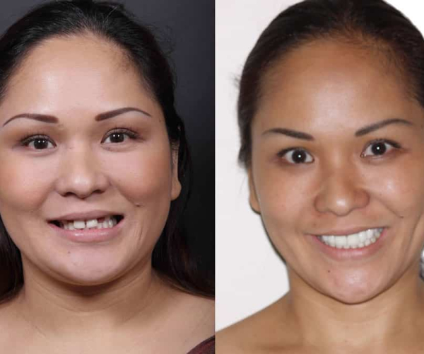 Ten porcelain veneers and gum lift to give patient a feminine smile
