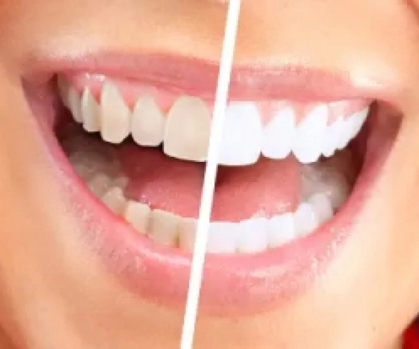 teeth-whitening.jpg-300x207